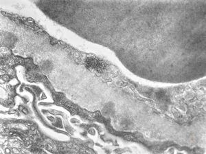 F,40y. | membranous glomerulopathy - lupus erythematodes (tubuloreticular organelle) F,40y. | membranous glomerulopathy - lupus erythematodes (tubuloreticular organelle)